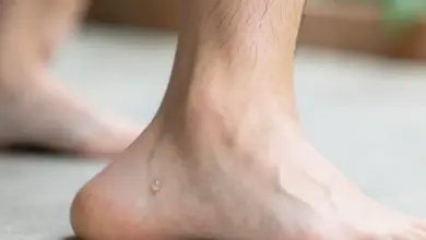 Jak léčit ganglion na noze - ilustrační foto