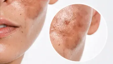 Přiblížený pohled na skvrny způsobené hyperpigmentací na tváři.