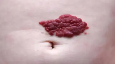 Červený hemangiom na kůži břicha nad pupkem