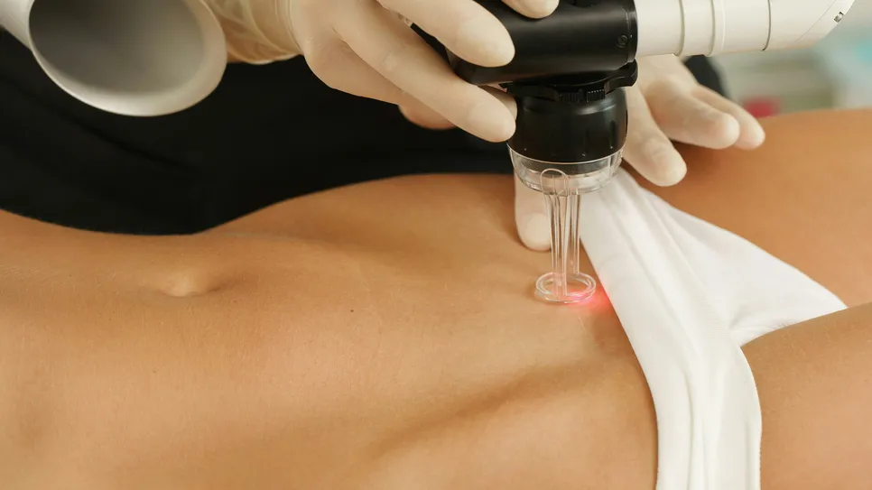 Laserová léčba kůže při odstranění kondylomů