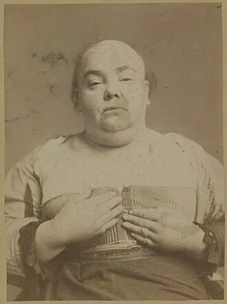 Historická fotografie osoby s příznaky myxedému.