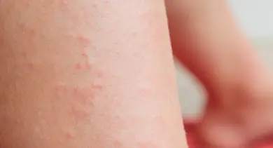 Kožní vyrážka na noze s malými červenými puchýři.