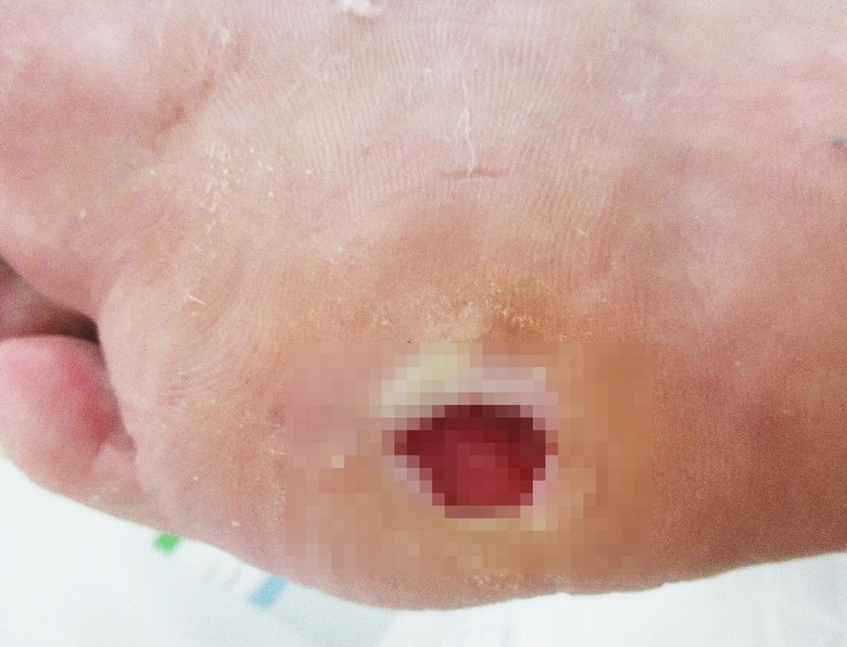 Otevřená rána na patě u diabetické nohy.