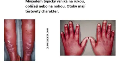 Zvětšené ruce a nohy s otoky typické pro myxedém.