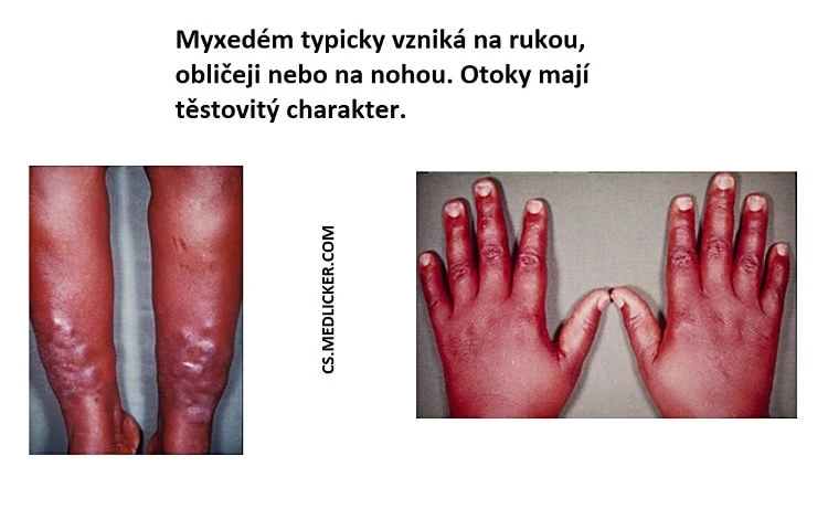 Zvětšené ruce a nohy s otoky typické pro myxedém.