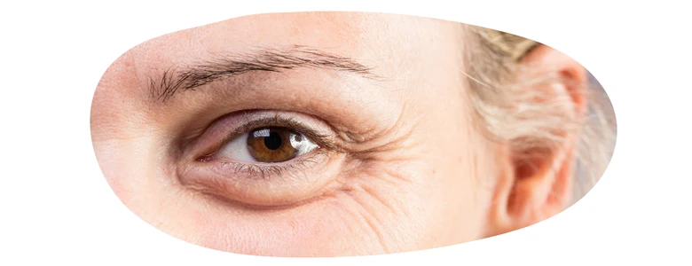 Human eye with bags