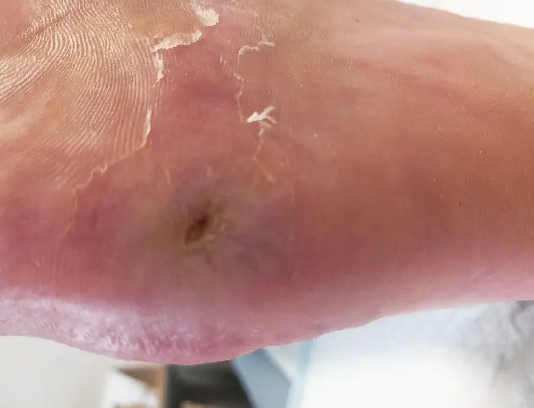 Fotografie diabetické nohy s vředem na patě.