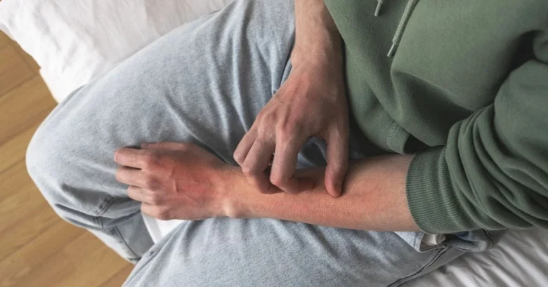 Muž dráždí červenou vyrážku na paži kvůli chladu.