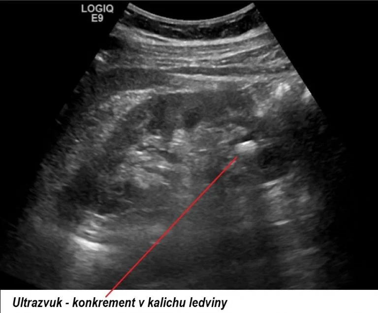 Ultrazvuk ledvin ukazující kamen v kalichu