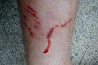Rána na noze po pokousání psem s krvavými škrábanci.