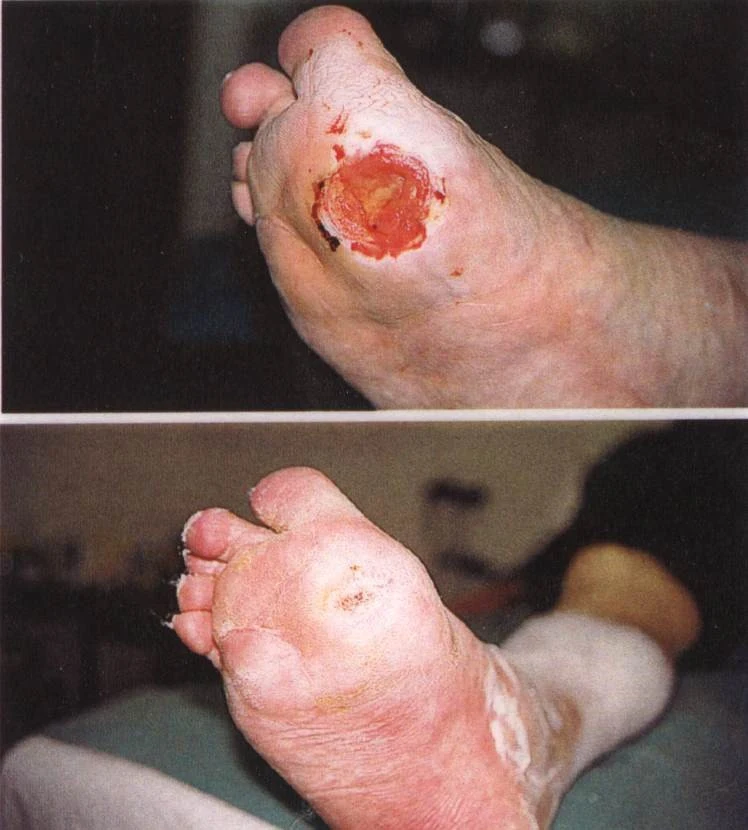 Předpozemní srovnání diabetické rány na noze před a po léčbě.